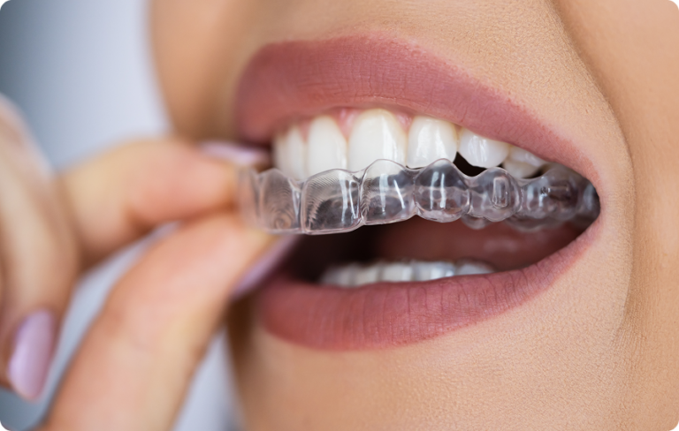 Close Up Of Woman Inserting Clear Aligners