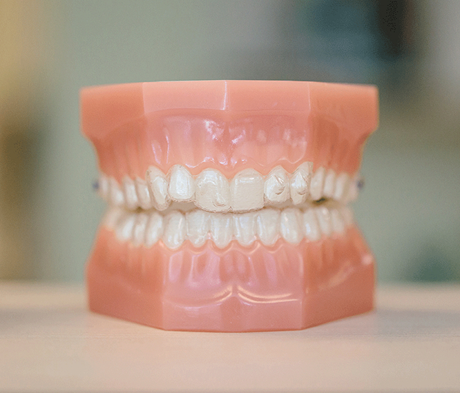 Model Of Teeth With Clear Aligners