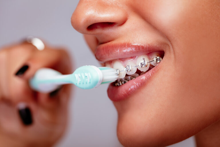 Close-up of a smiling woman face with braces on white teeth and toothbrush.