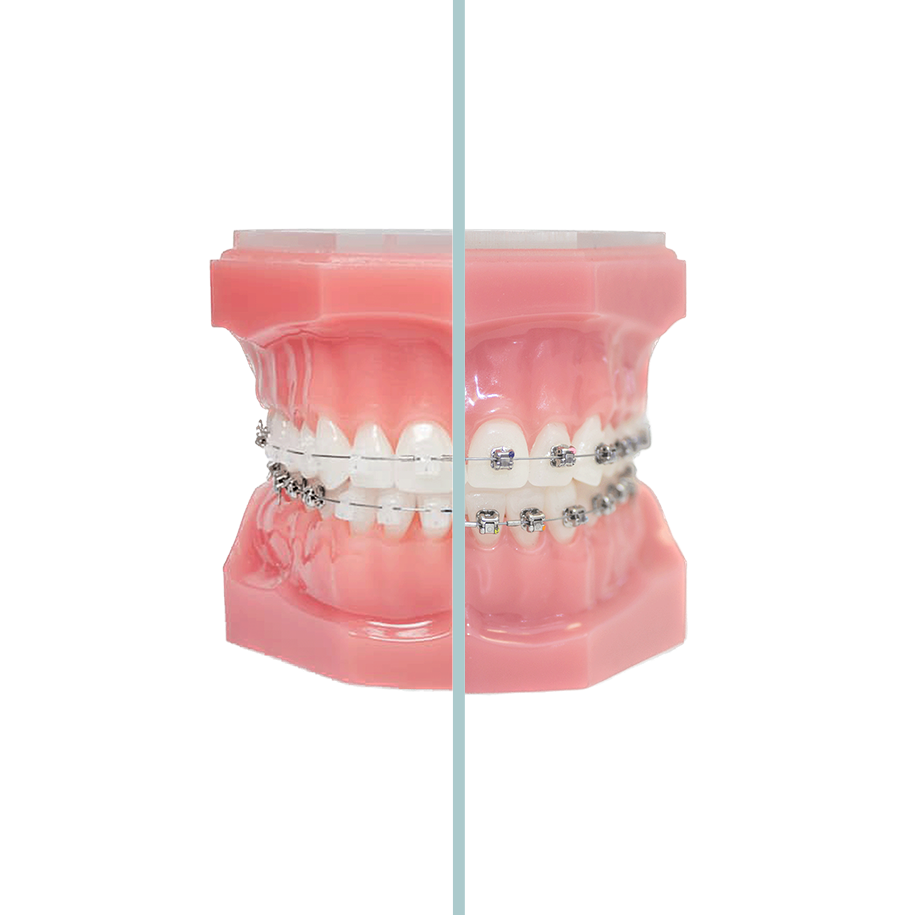 Exmple Clear And Metal Braces